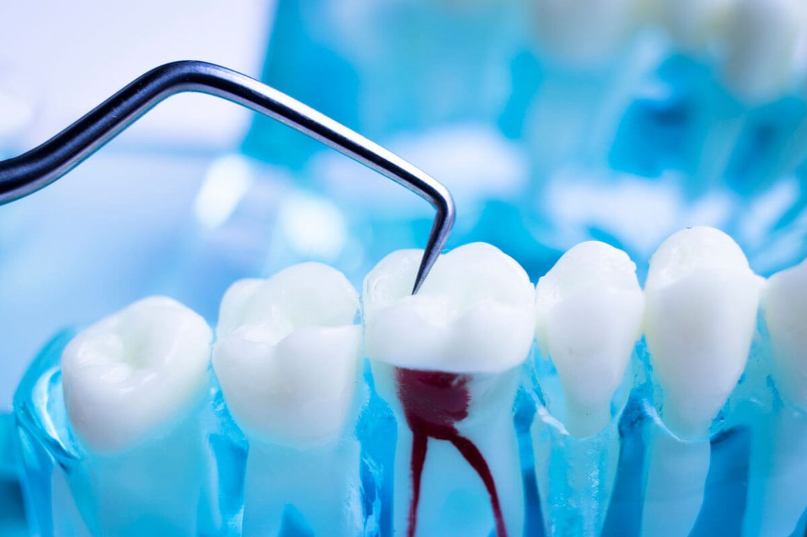 How Much Does a Root Canal Cost With and Without Insurance? AWS Rails